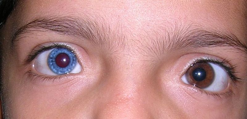 Human Heterochromia