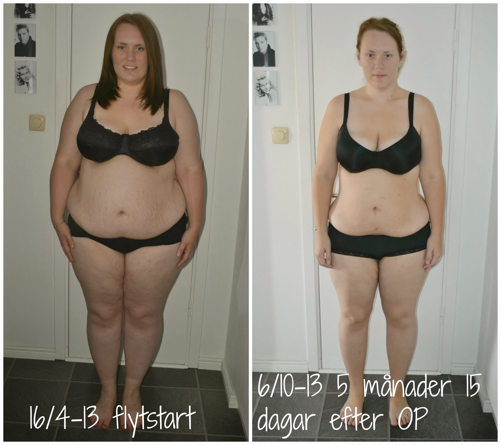 viktnedgång gastric bypass viktnedgång gastric bypass