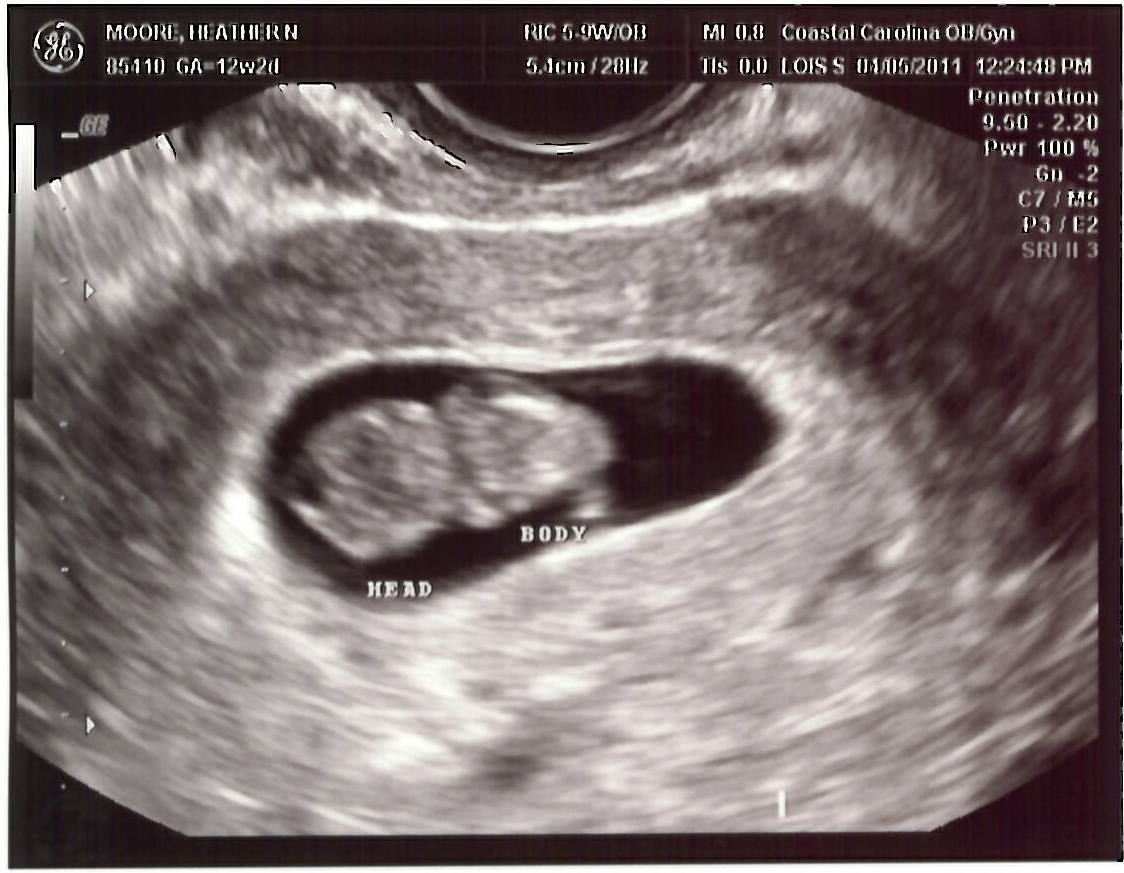 When do you have dating ultrasound
