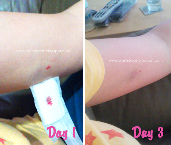 birth control implanon looks before bruises know method arms normal scary few pretty days