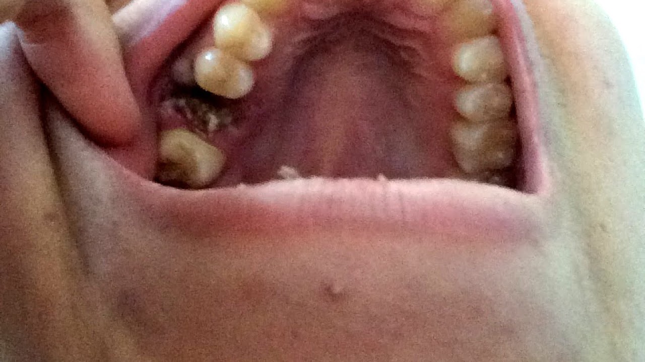 What Are Dry Sockets Sock Choices