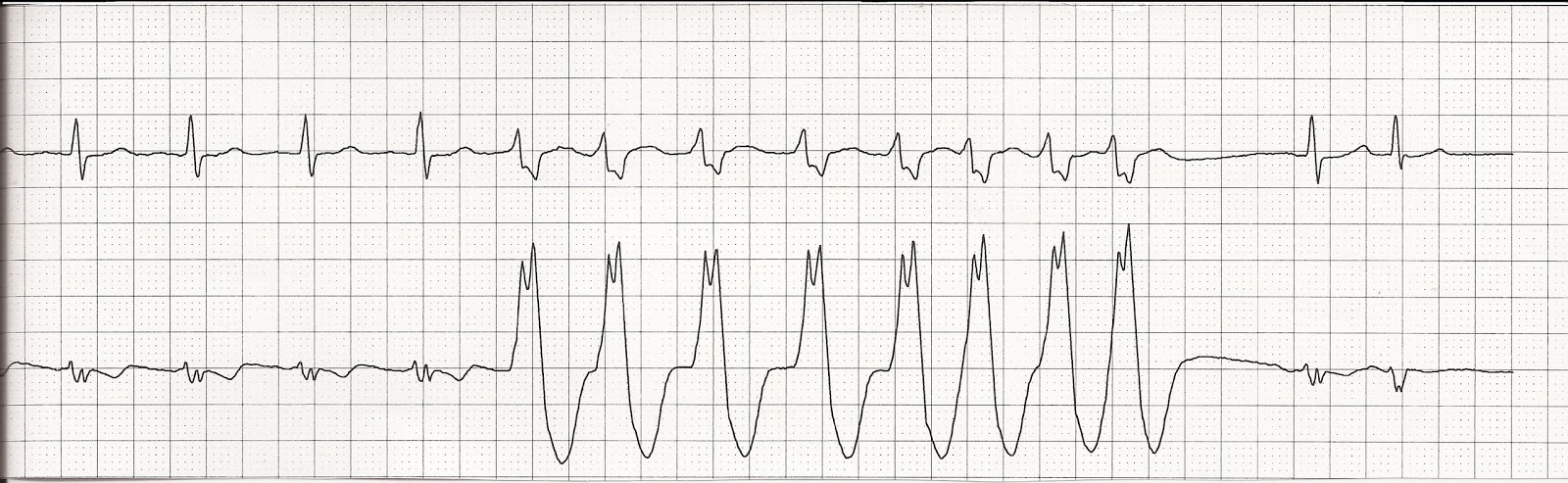 Ekg Nsr