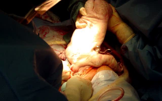 Breech delivery maneuvers cesarean picture