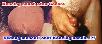 Kencing perih keluar nanah Kencing perih keluar nanah