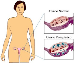 ovario poliquistico