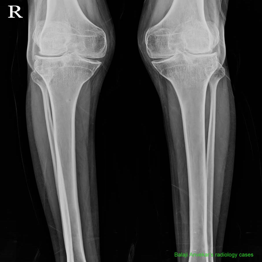 Dr Balaji Anvekar FRCR Pseudo Achondroplasia