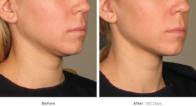 Ultherapy-Before-And-After-Chin