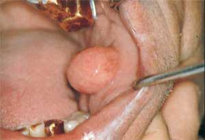 LIPOMA PPT lipoma ppt: