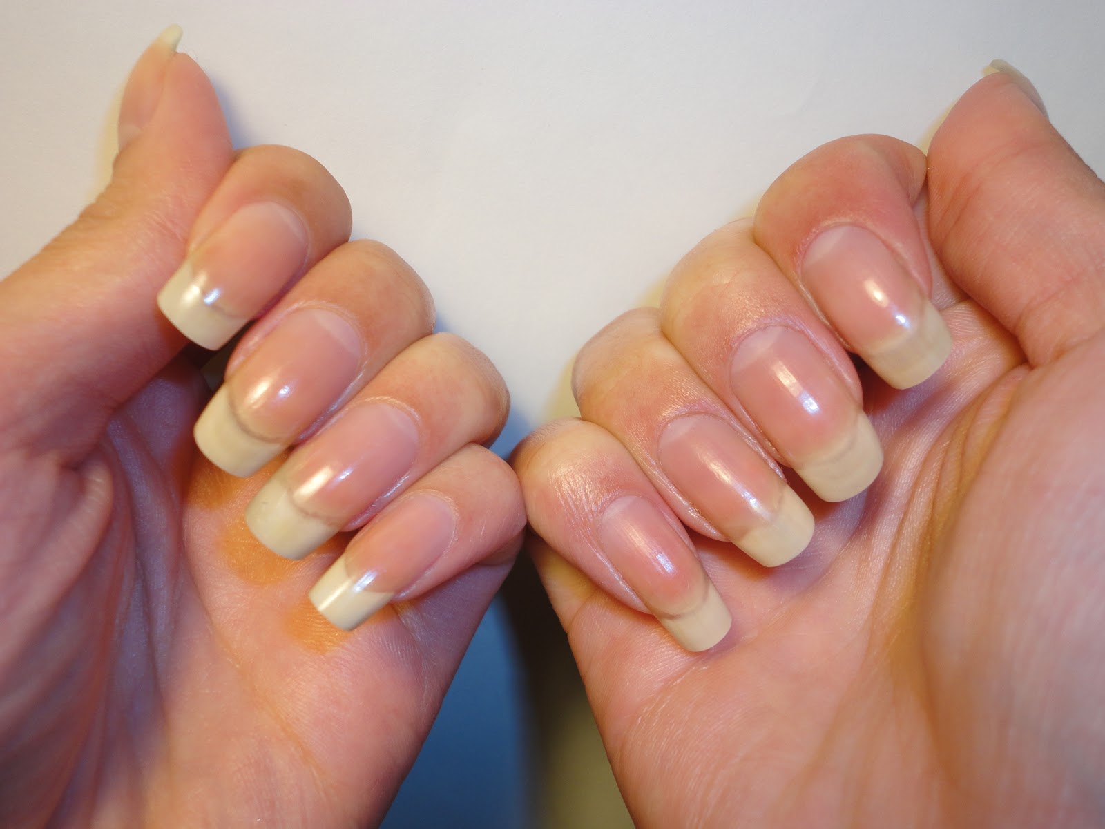 Nail Not Growing Normally^*