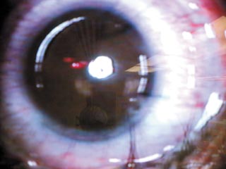 Steroid induced glaucoma causes
