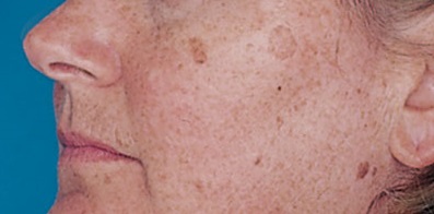 sun spots dark skin age damage hyperpigmentation cancer melasma exposure aging dull wrinkles caused typically attributed actually