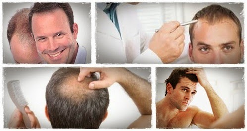 Hair Loss Blog What Are The Indicators Of Hair Loss In Male