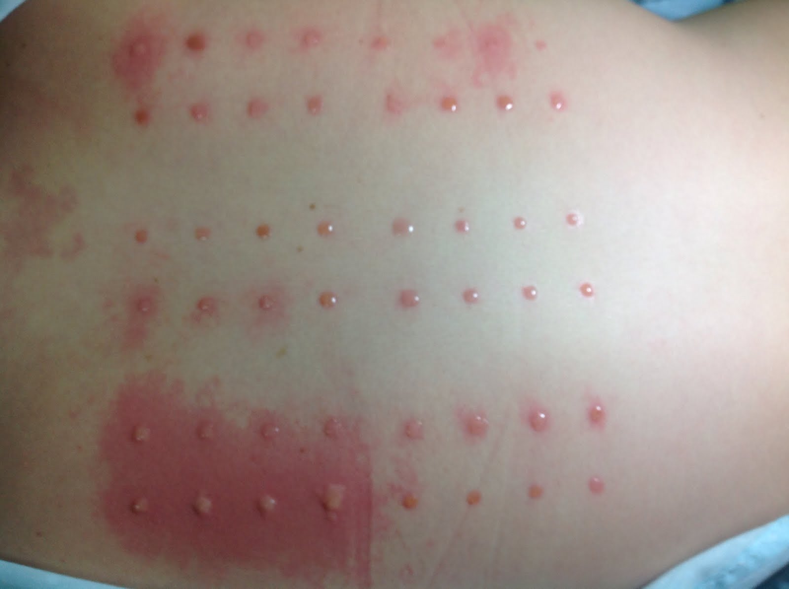 Por que surge la psoriasis de las uñas