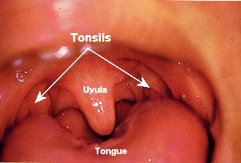 tonsils removal with radio