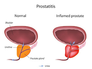 prostate prostatitis enlarged kidney solution cancer safe simple inflammation bladder