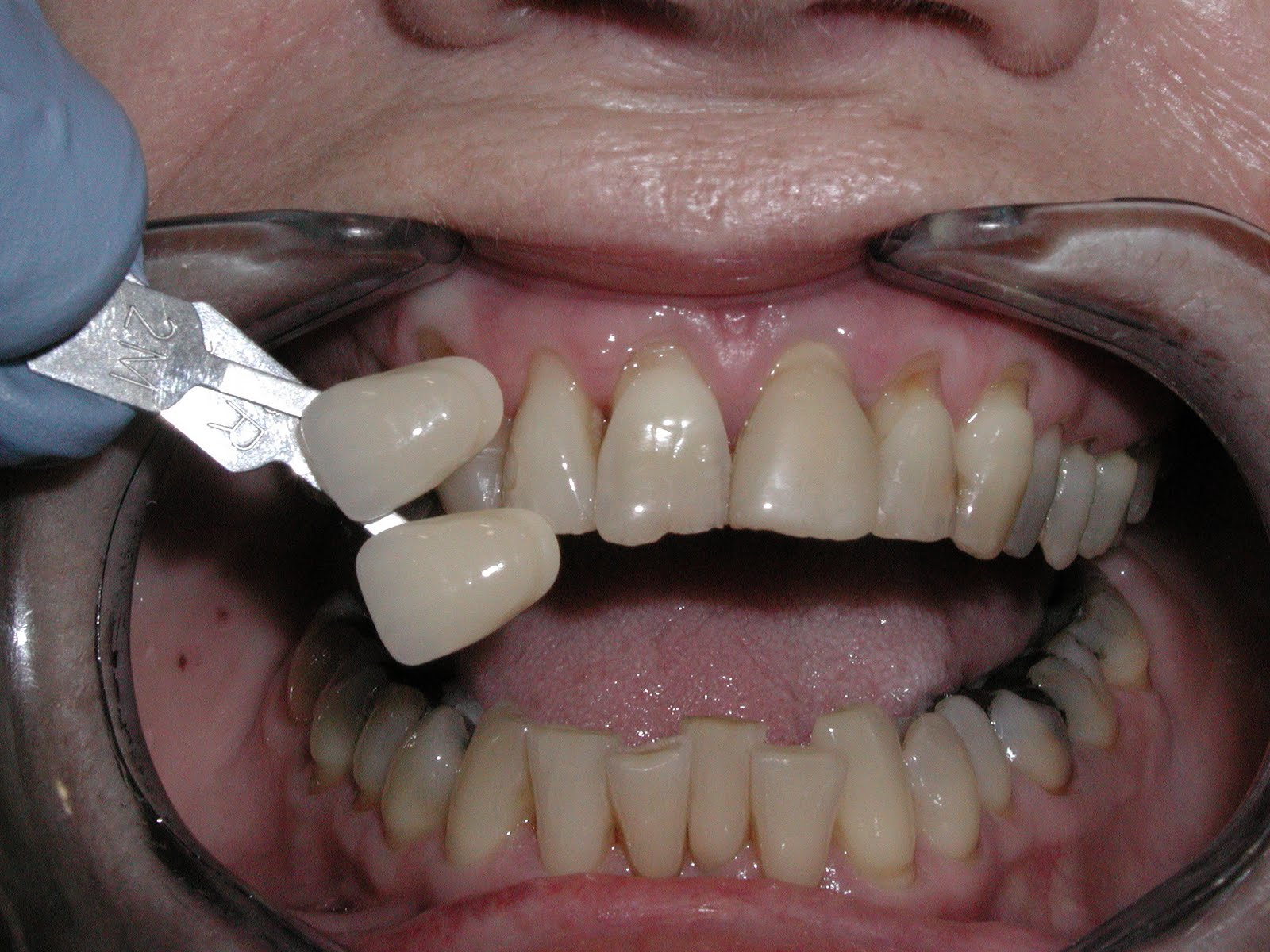 SBO Dental Laboratory The importance of the underlying tooth shade for