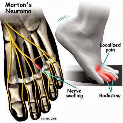 are chacos good for morton's neuroma