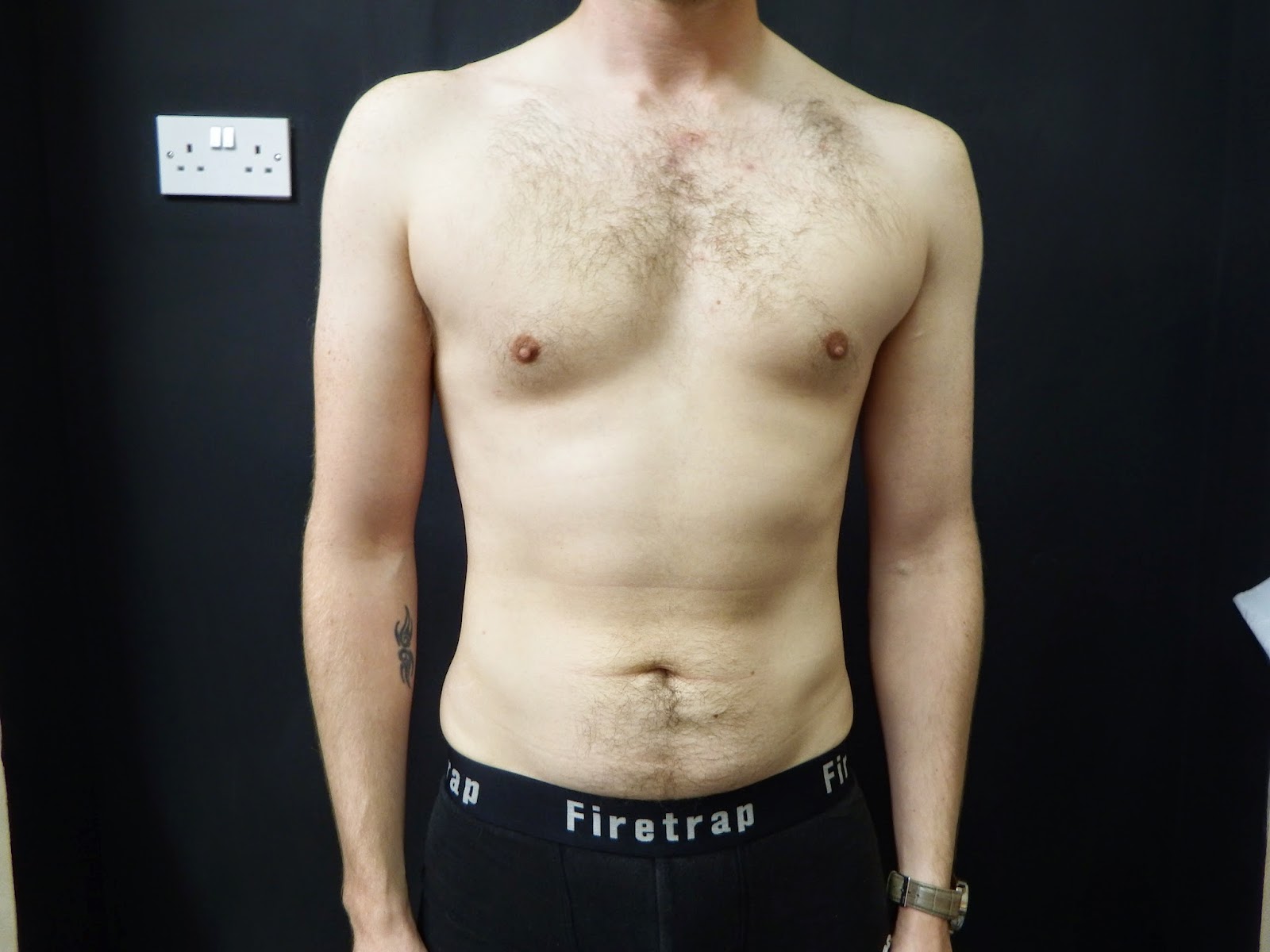 Selston Cosmetic Clinic Vaser Lipo...2 weeks on.