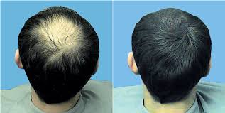 Viral News How To Regrow Hair On Bald Head Powerful Natural