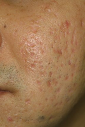 Deep Acne Scars