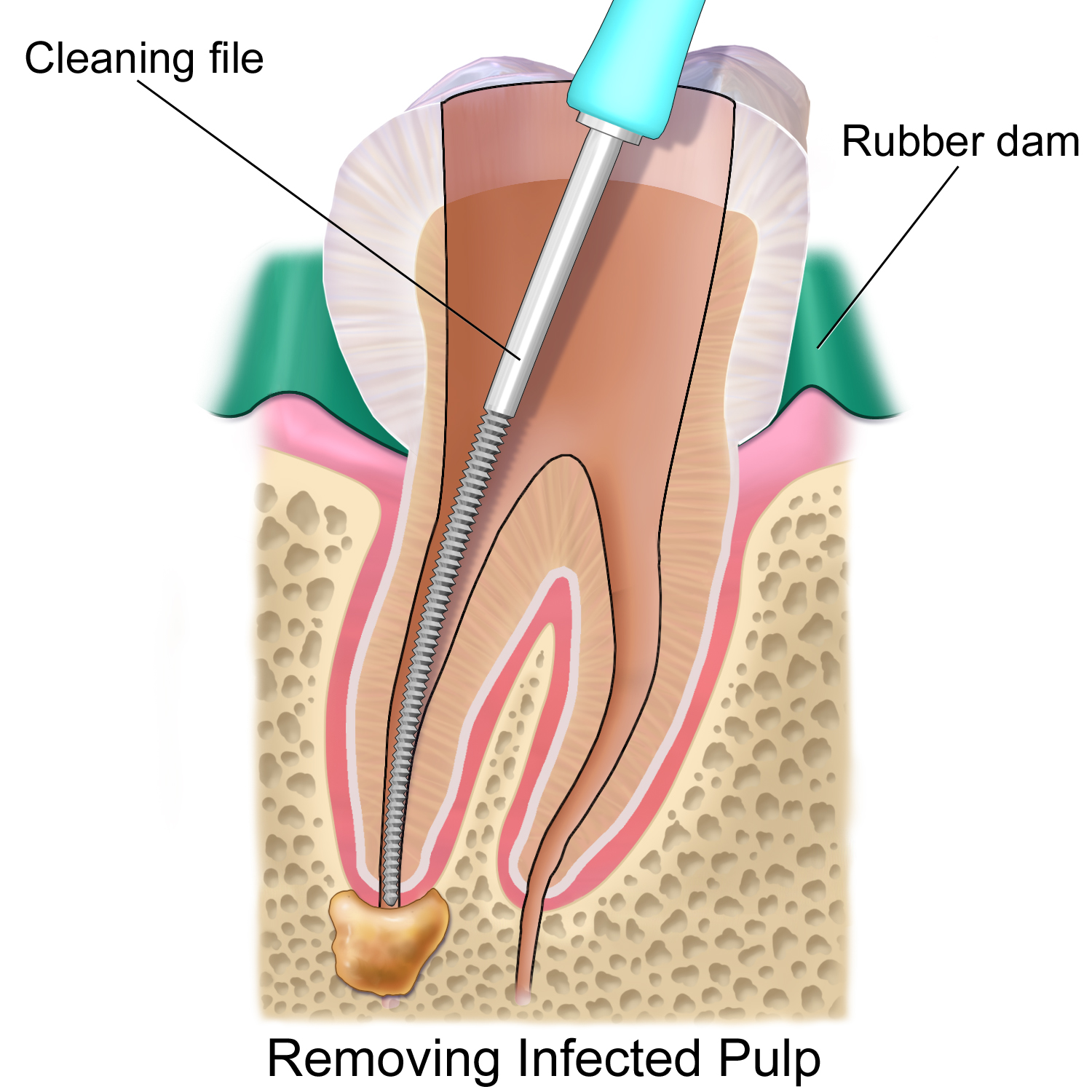 http://laserdentalclinicbangalore.com/laser-assisted-root-planing.php