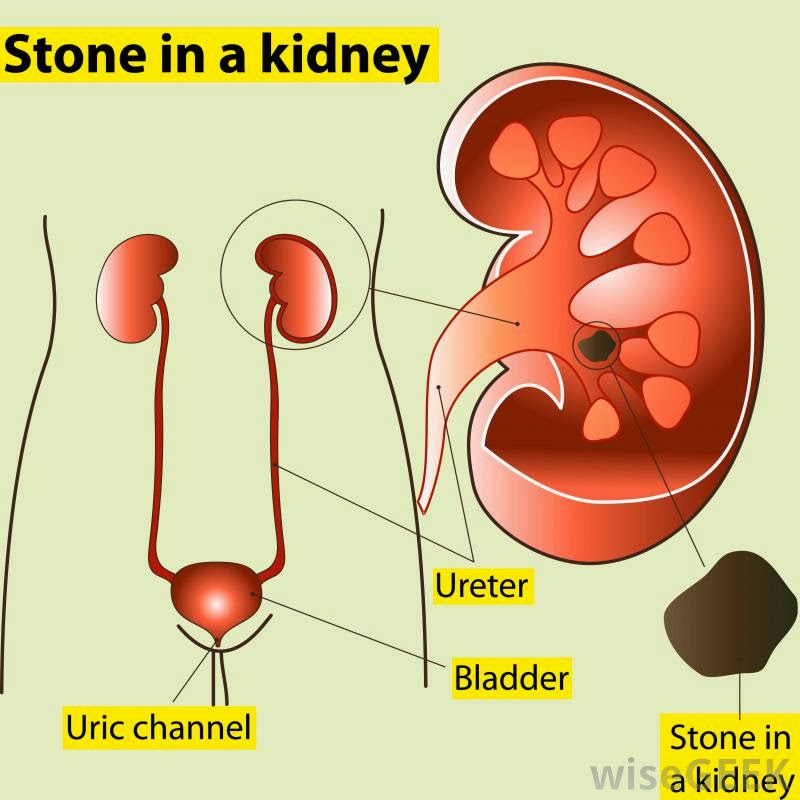 do calcium channel blockers cause kidney stones