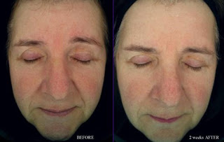 hydropeptide wrinkle anti eye dark concentrate circle toward cruelty leaves friendly extra company