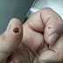 Warts:  What Are They?
