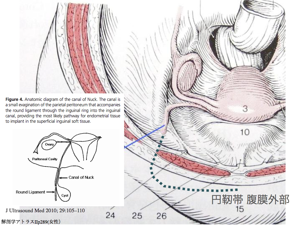 Hospitalist なんでも無い科医の勉強ノート 下腹部痛の鑑別 Inguinal Endometriosis