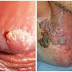 Harga Obat Kutil Kelamin Ampuh Pada Wanita thumbnail