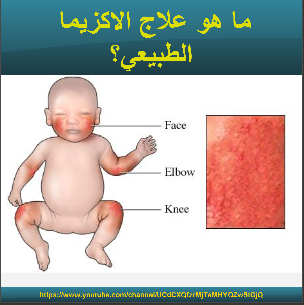 Abdelhadi Chambet Hezerdja ما هو علاج الاكزيما الطبيعي
