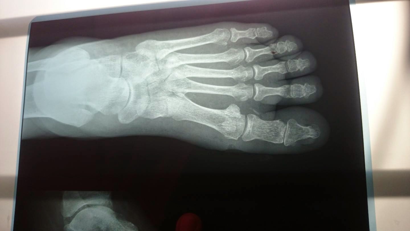 ATENCION ESPECIALIZADA EN PIE DIABETICO CURACIÓN AVANZADA DE PIE