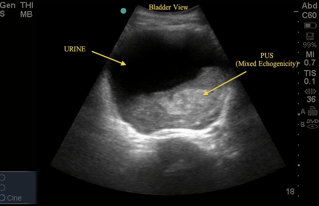 Urinary Retention ~ Ultrasound Cases Info