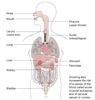 Merokok dan Kanker
