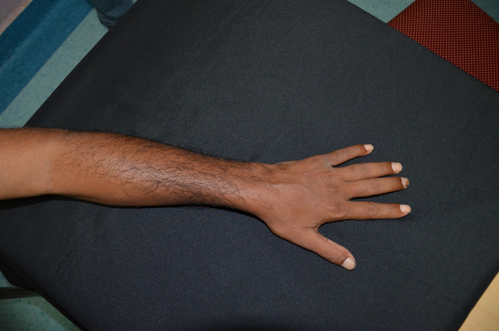 CRUSH INJURIES OF HAND AND UPPER LIMB INJURIES OPEN FRACTURE BOTH BONE