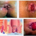 Obat Ambeien Eksternal thumbnail