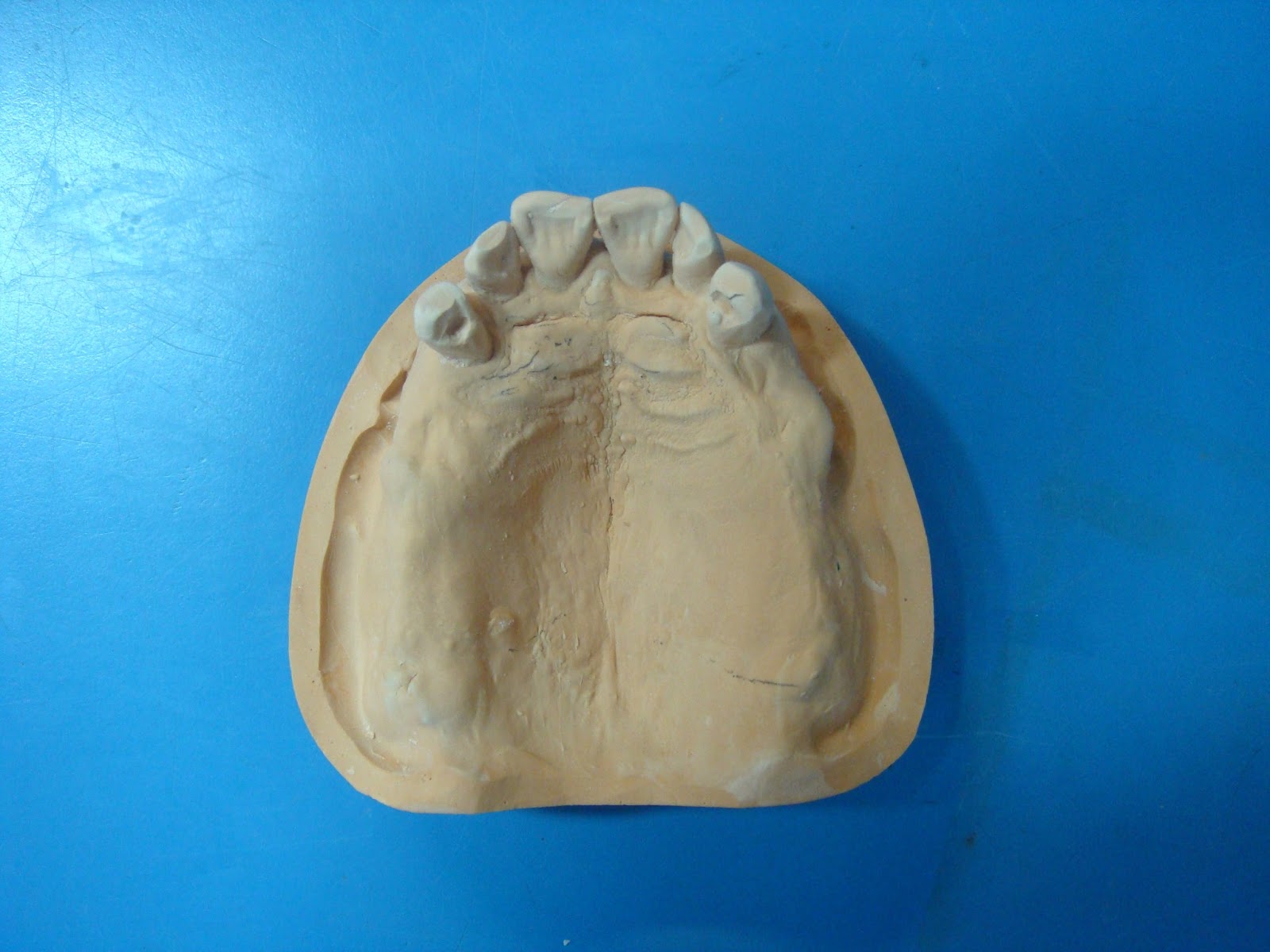 Step by step Guide for Understanding the Prosthodontics A step by step