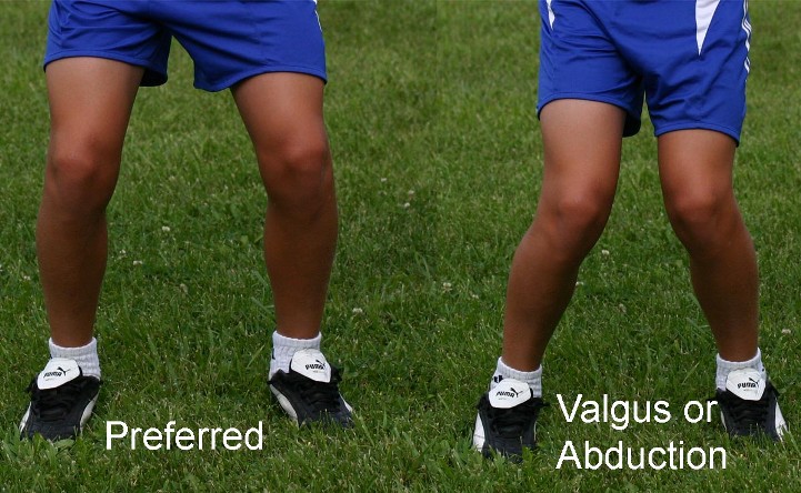 knee-valgus1.jpg