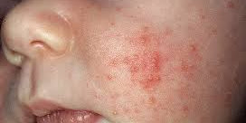How do You Get Rid of Baby Acne