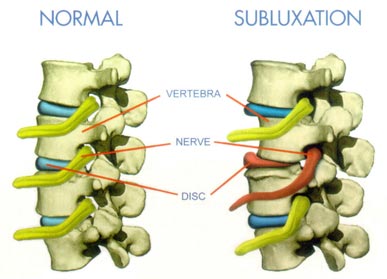 Chiropractic Subluxation Chart