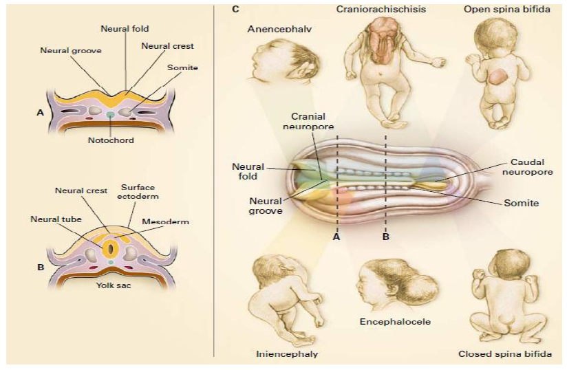 Neural Tube Defects Causes Diagnosis Treatment And Pr vrogue.co