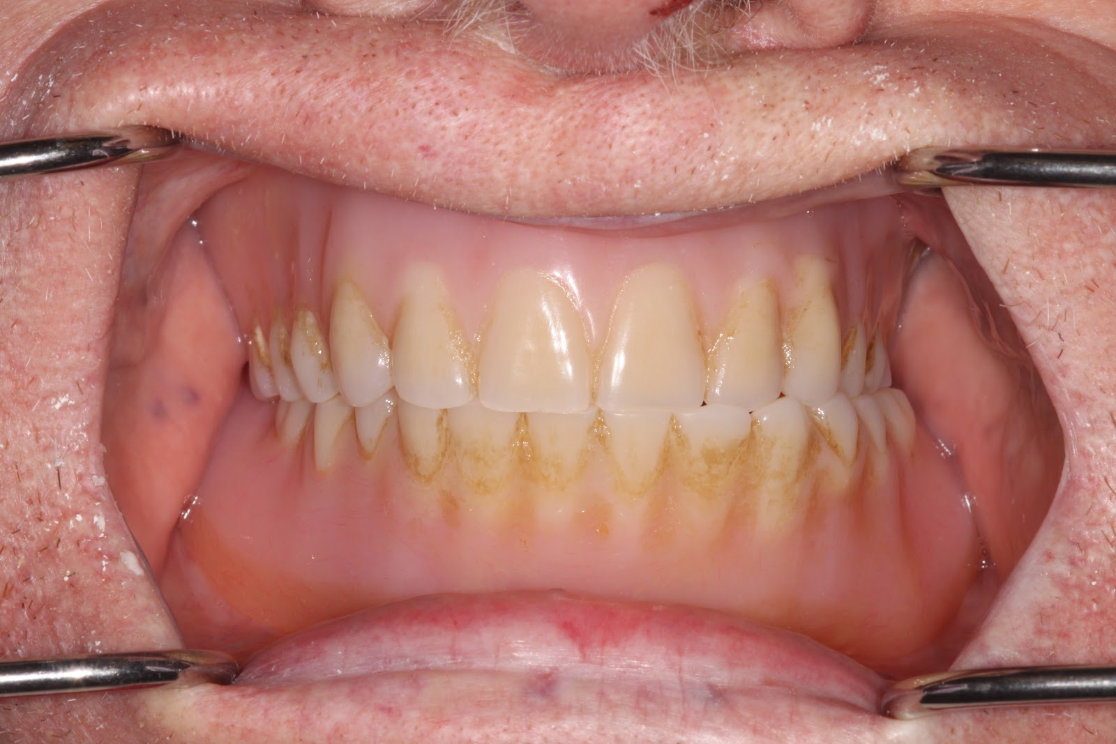 Boise Idaho Prosthodontics Maxillary Complete Denture / Mandibular