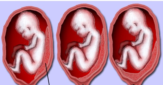 What is Placenta Previa? Definition, Symptoms, Causes, and ...