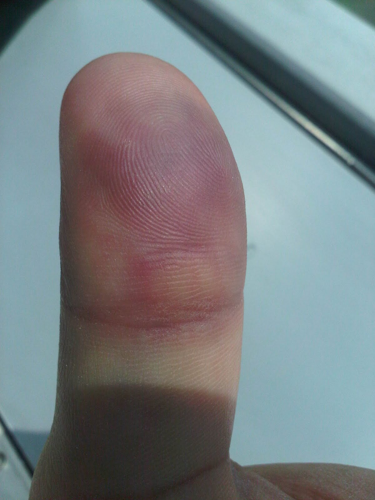 Moriarty's Musings Ode to my left thumb