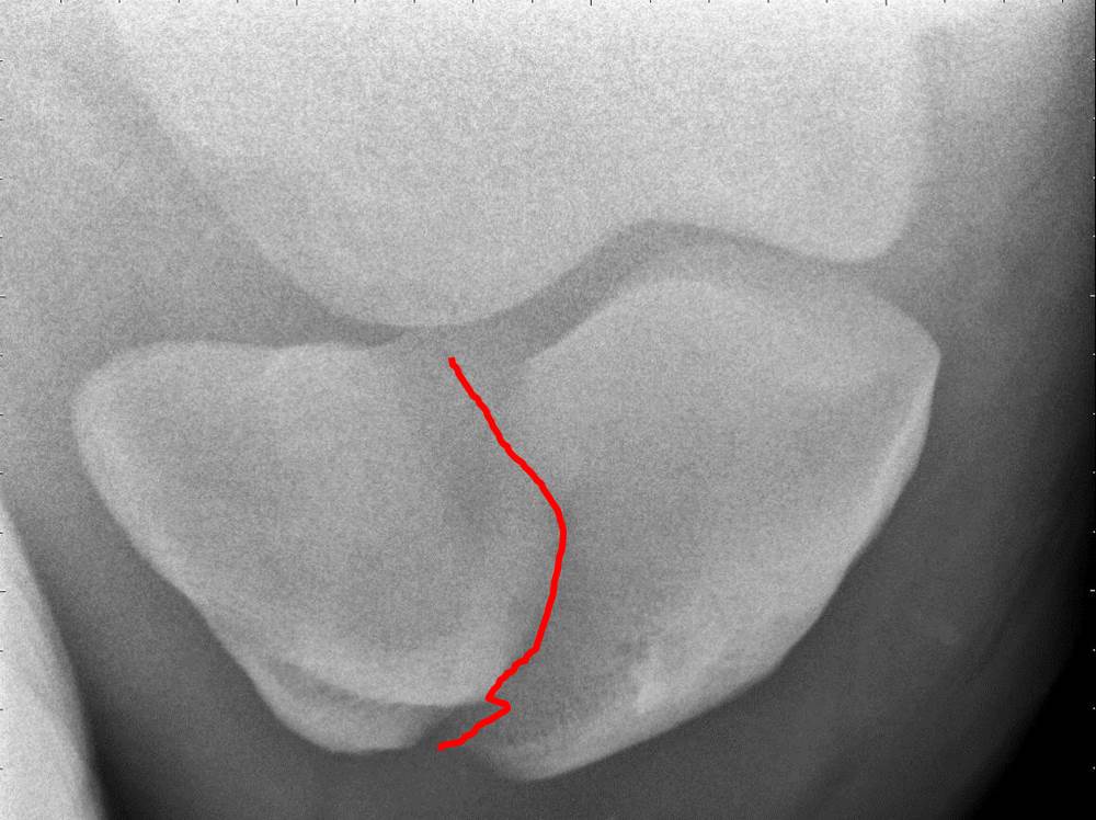 Michael Porter, Equine Veterinarian Fractured Patella in a Horse
