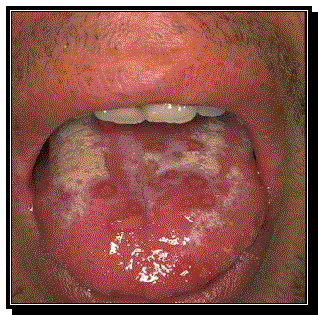 Primo infection herpes oral