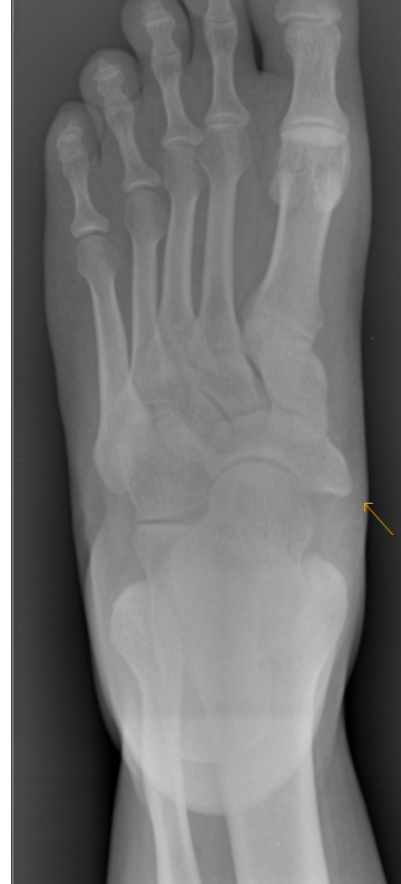 Accessory Navicular Syndrome