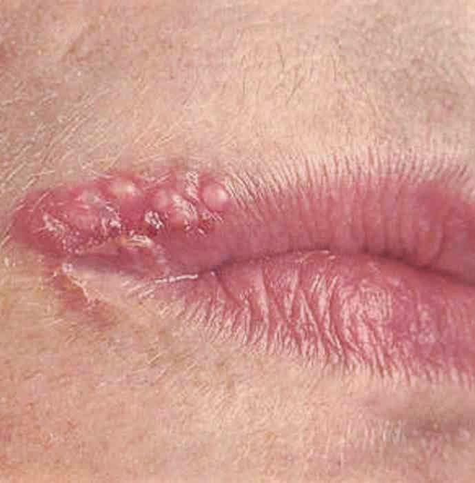 herpes simplex.