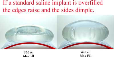 Thoughs on the Ideal silicone / saline breast implant. 