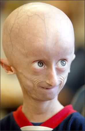 progeria life span